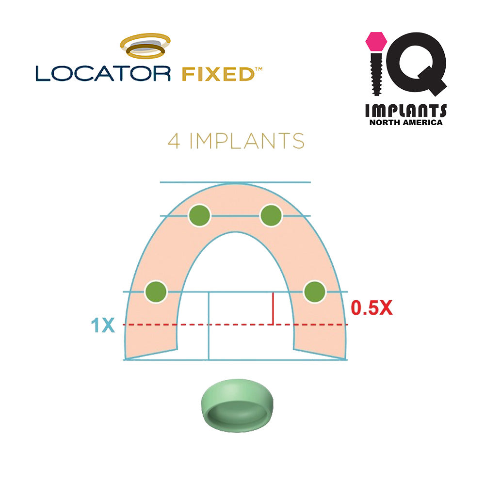 LOCATOR FIXED Essential Patient Education Model - IQ IMPLANTS USA