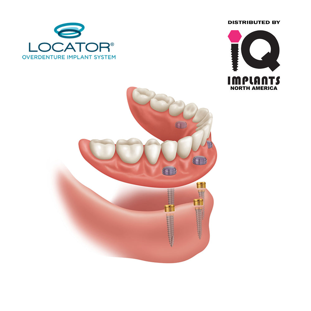 LOCATOR Implants (LODI) full 2.4-4.9mm Range, Implants Only