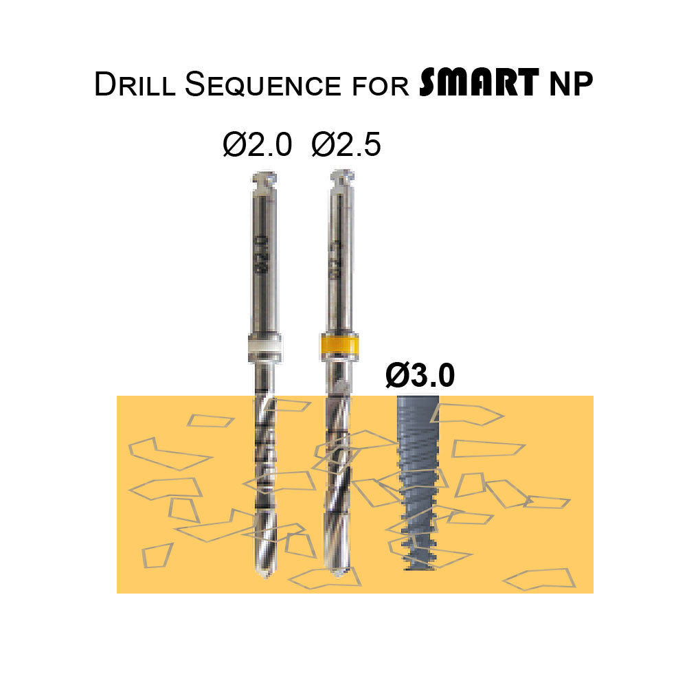 Smart Implant NP (Narrow Platform)